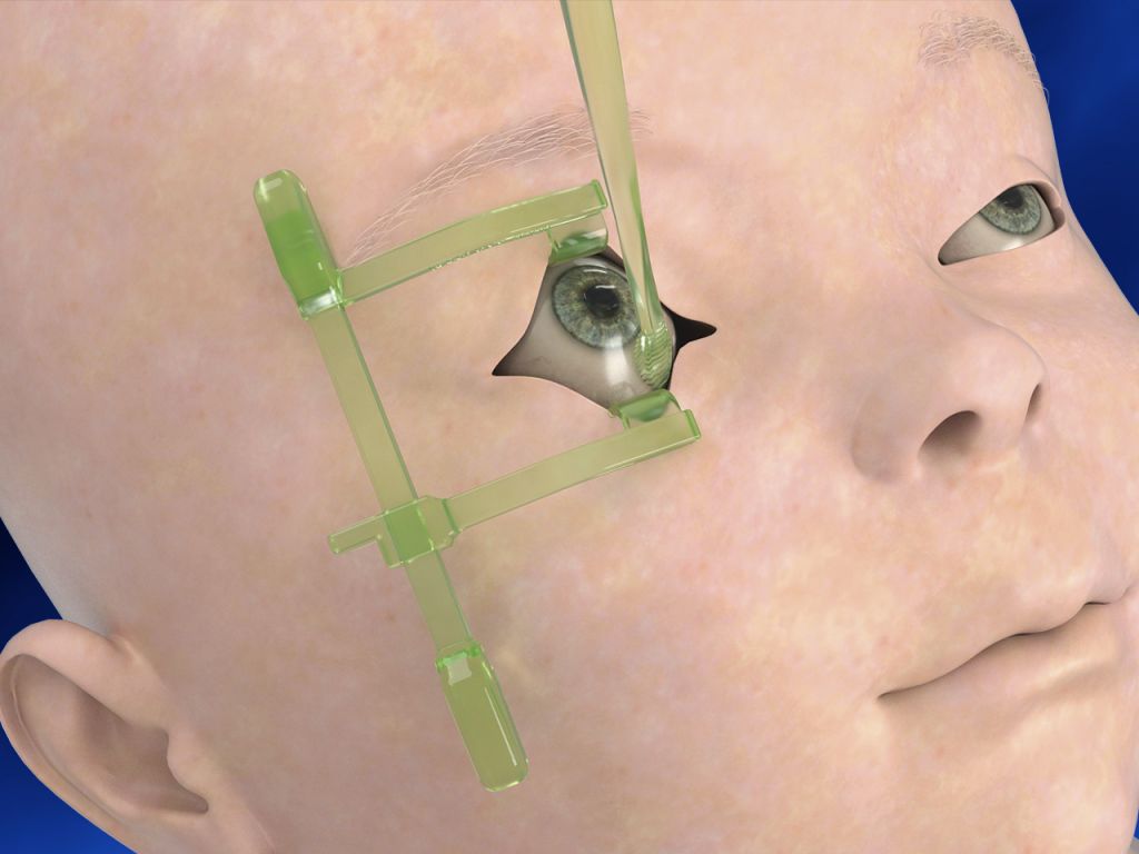 3D rendering of Ocular Exam Kit (OEK) used on patient.