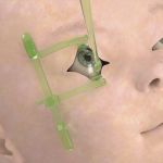 The disposable Ocular Exam Kit is ideal for ROP exams