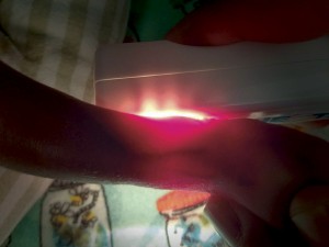 NeoGlo in use on ankle | Vein Finder