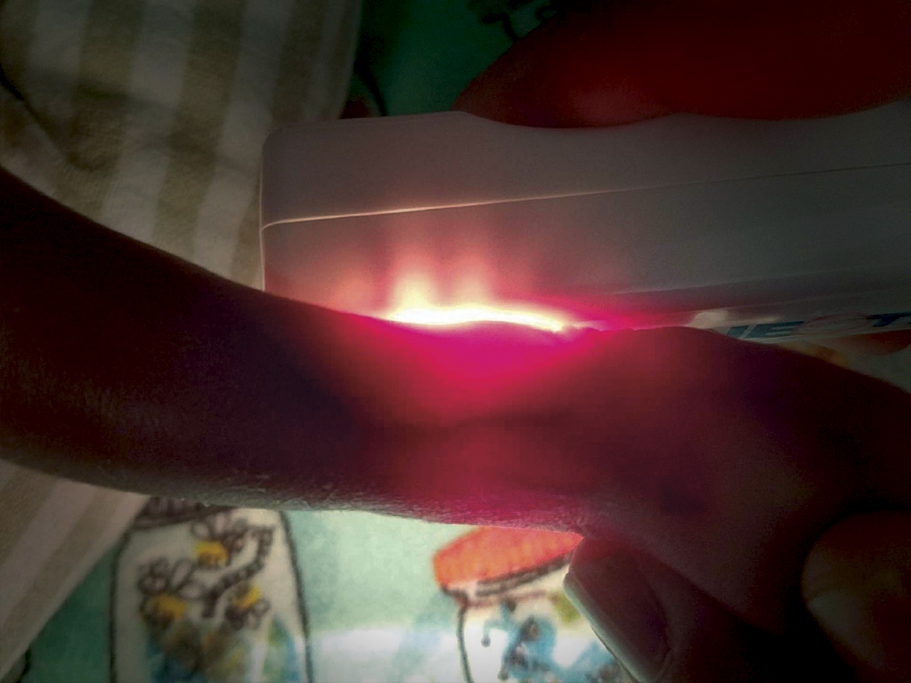 NeoGlo Transilluminator in-use on ankle