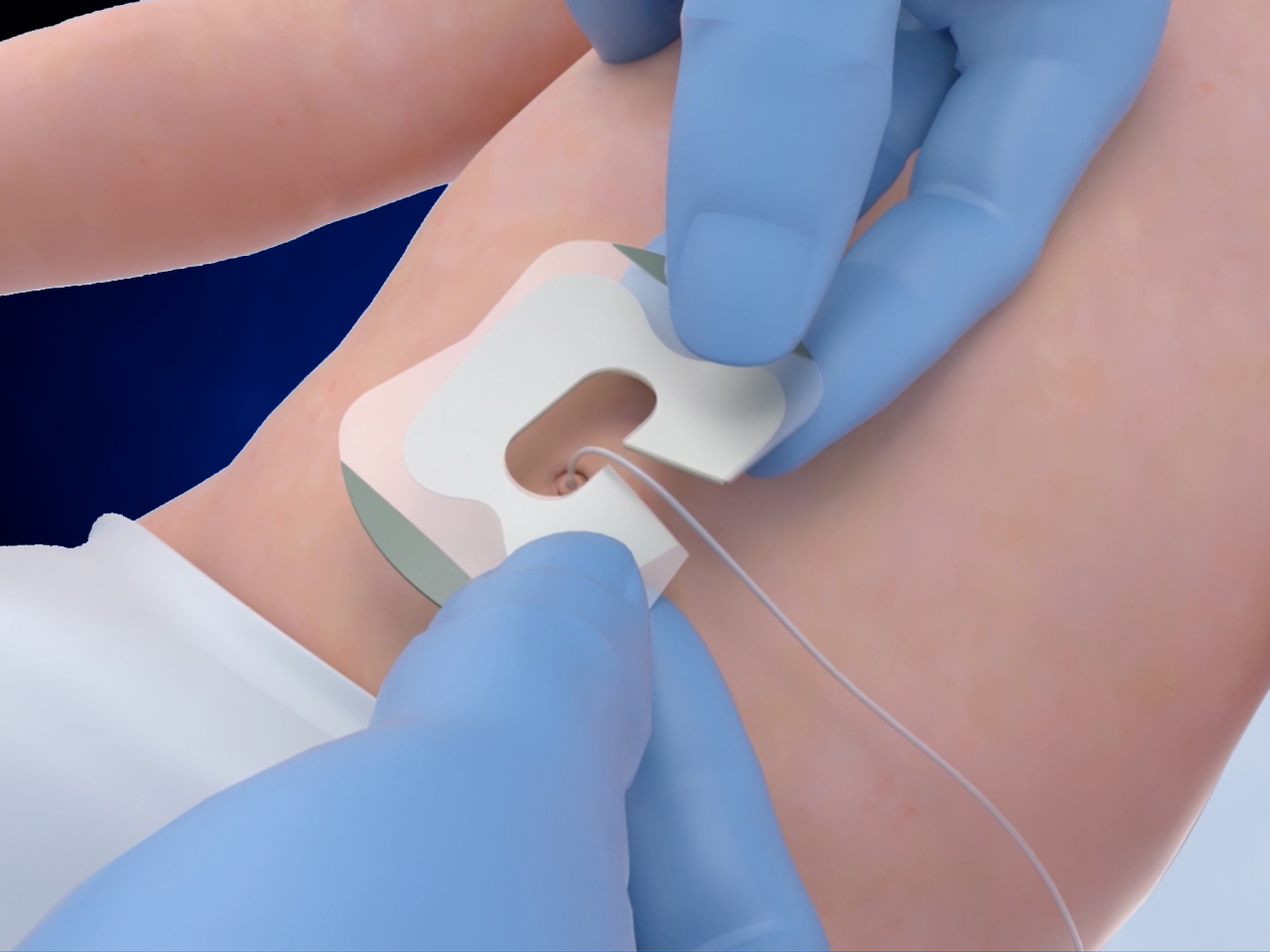 Apply NeoBridge around catheter