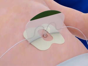 NeoBridge Umbilical Catheter Holder in use