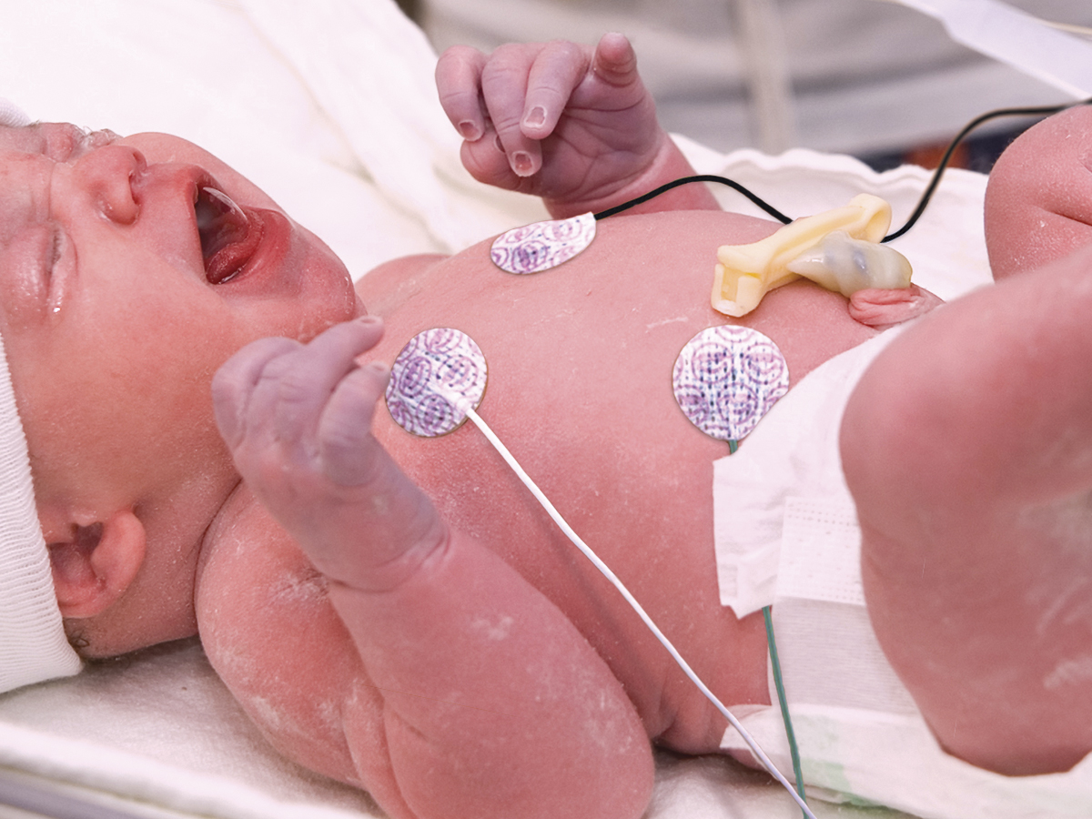 Tiny skin friendly N300 Mini NeoLead neoantal electrodes in use on preemie