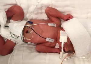 Preemie with Hold-A-Line, NeoBar, and Micro NeoLead tiny electrodes