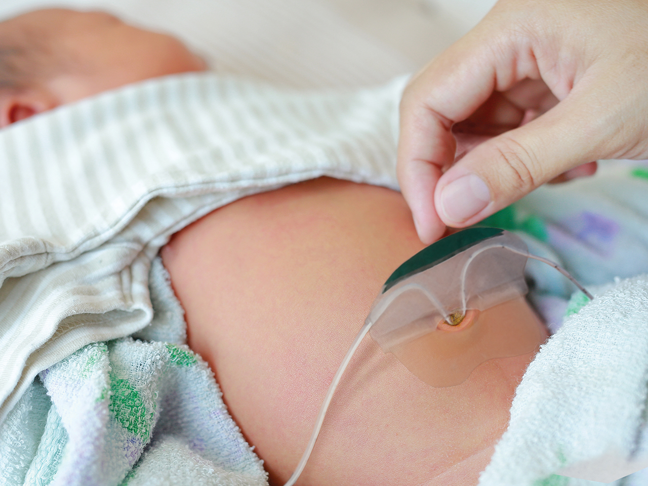 NeoBridge featuring neonatal adhesive, hydrocolloid, in-use on baby.