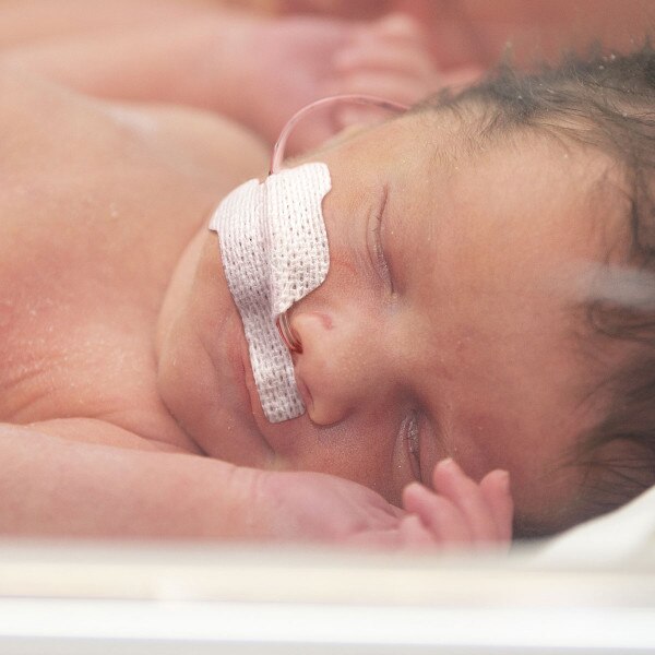 N7015 Left Small NeoSnug securing nasal feeding tub close to the nares on baby